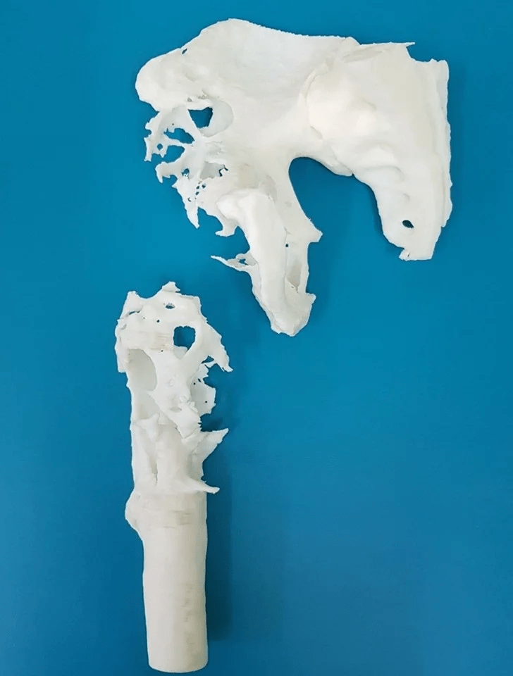 3d ендропротез